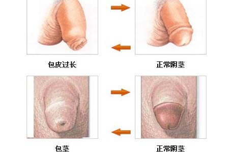 男性包茎的危害有哪些