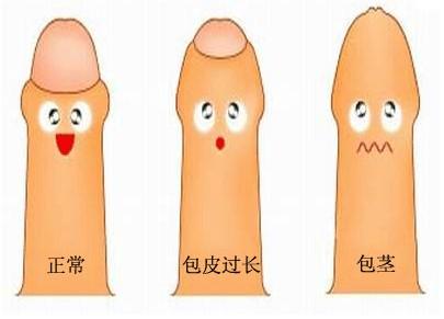 包皮过长需要做哪些检查
