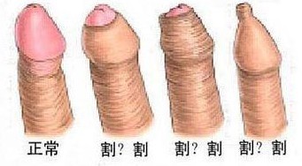 男性包茎的危害主要有哪些