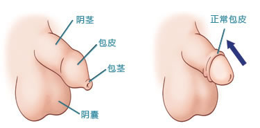 包皮过长与包茎的区别有哪些